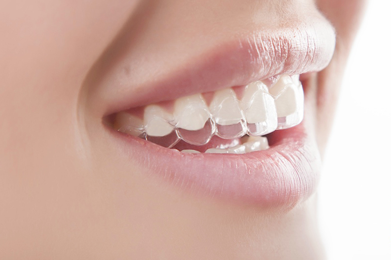 Элайнеры для выравнивания зубов: что это и как устанавливаются?