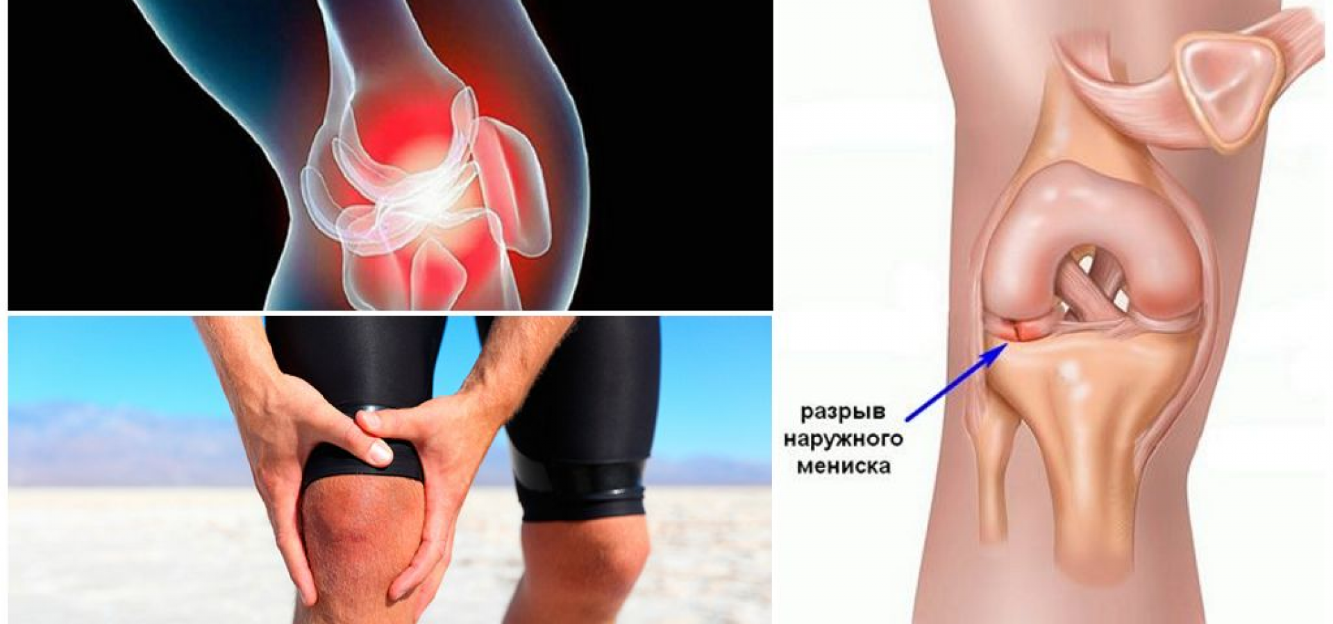 Как лечится мениск коленного сустава?