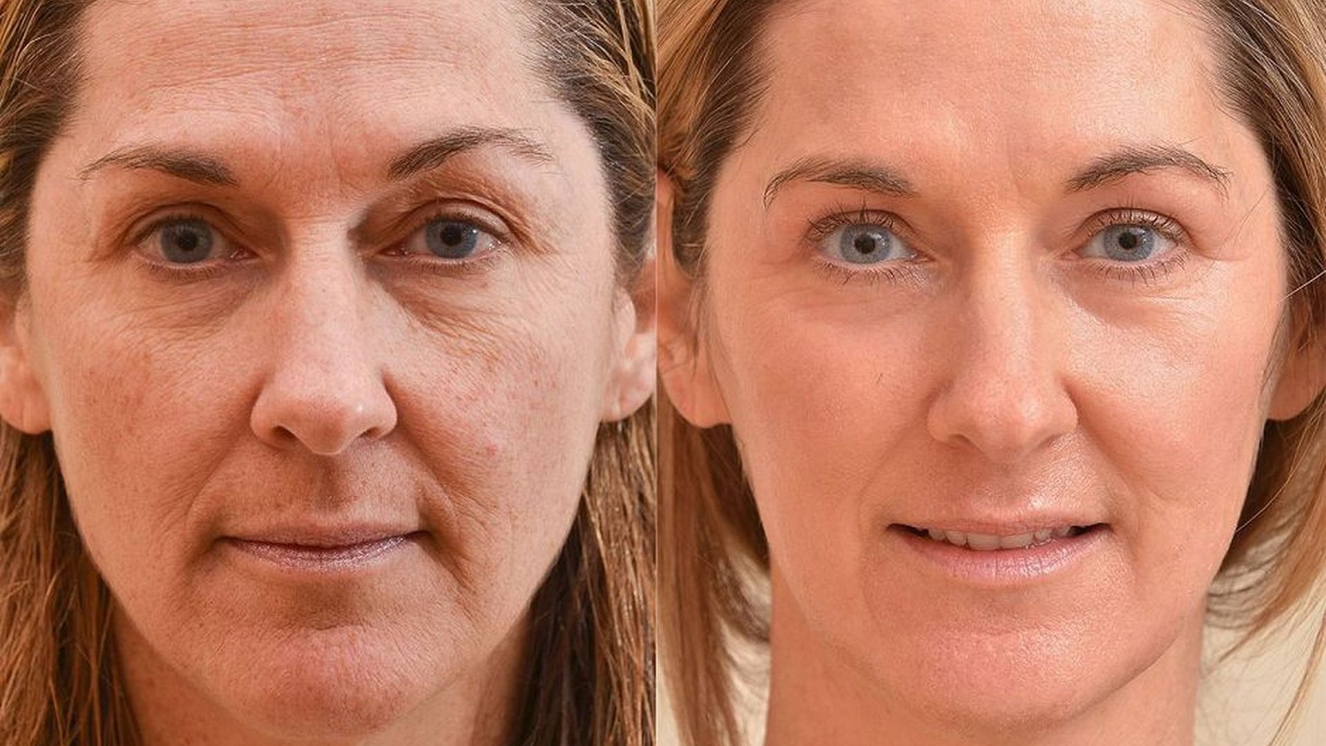 Кожа после. Омоложение лица до и после. Атоничная кожа лица что это. Морщины до после. Плазмолифтинг лица до и после.