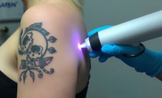 Удаление татуировок пикосекундным лазером: что нужно знать, прежде чем решиться