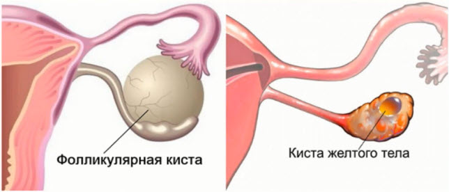 Причины, симптомы и лечение фолликулярной кисты яичника